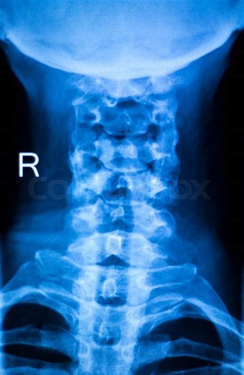 Painful Neck And Spine Injury X Ray Scan Traumatology And Orthopedics