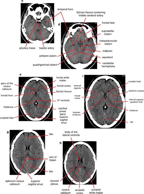 Anatomy Of Head Ct Scan Normal The Brain On Ct And Mri With A Few