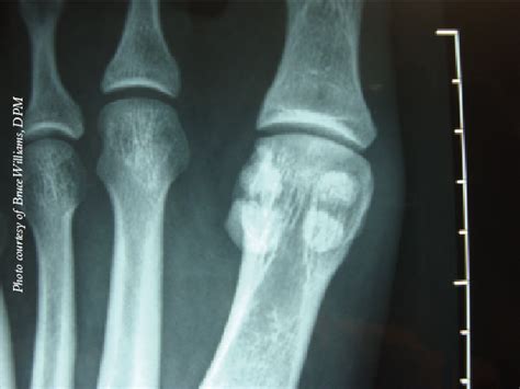 A Comprehensive Guide To Reviving The Sick Sesamoid Podiatry Today