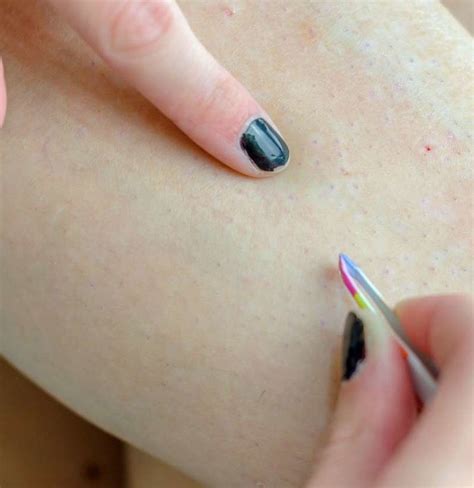 List 99 Pictures Do Ingrown Hairs Hurt To Touch Sharp
