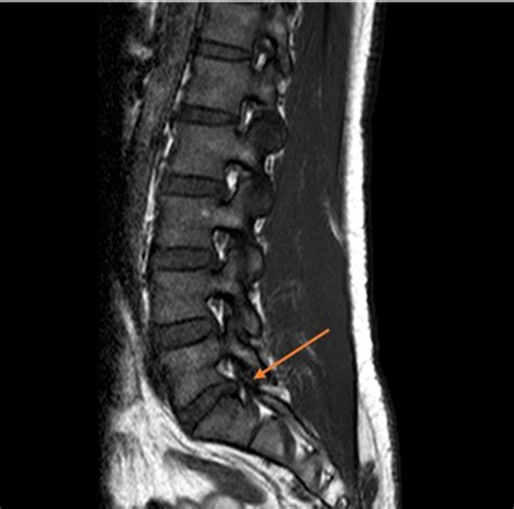 Mri Of The Lumbar Spine Showed Degenerative Retrolisthesis Of L On S