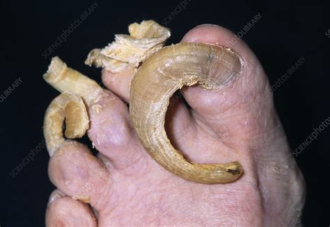 Fungal Infection Stock Image M2700237 Science Photo Library