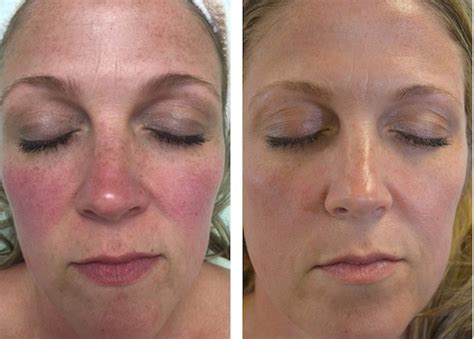 Professional Skincare Before And After Photos Rosacea Rhonda