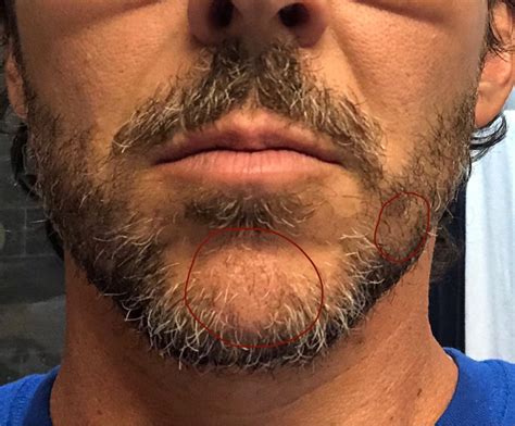Patchy Beard Success Stories Before And After Photos Page 36 Beard Board