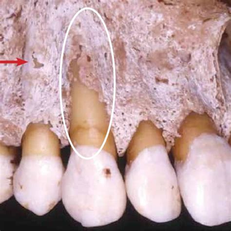 Occlusal Trauma With Thickening Of The Lamina Dura White Arrow And