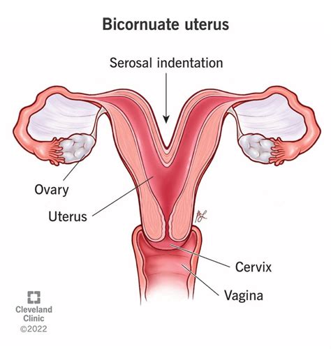 Bicornuate Uterus Double Uterus Symptoms Treatment