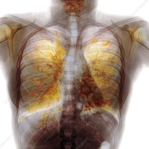Cystic Fibrosis X Ray Stock Image C0119709 Science Photo Library