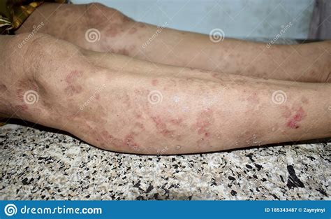 Psoriasis Or Fungal Infection Called Tinea Corporis On Leg Of Southeast