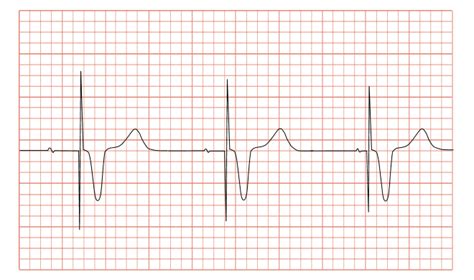 Pacemaker Syndrome Wikidoc