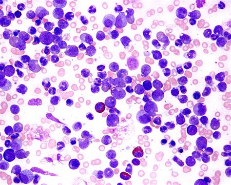 What Is Chronic Myelogenous Leukemia An Overview Of The Rare Cancer