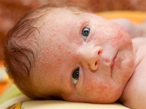 Baby Acne Treatment For Newborn Acne