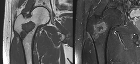 The Mri Appearances Of Cancellous Allograft Bone Chips After The