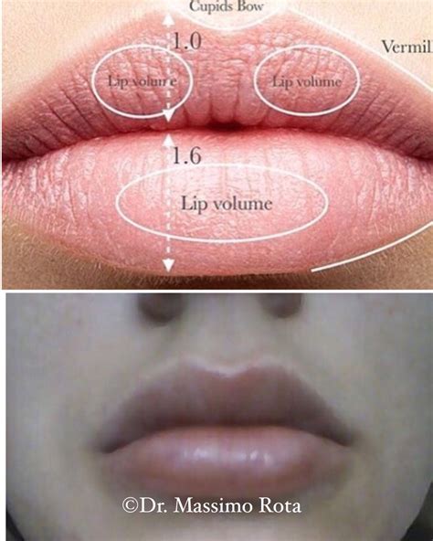 Filler Lips Theory Vs Reality Good Result Good Technique And