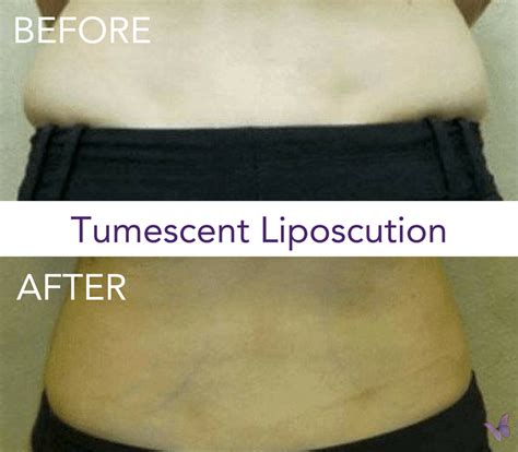 Tumescent Liposuction Body Contouring Derma Health Institute