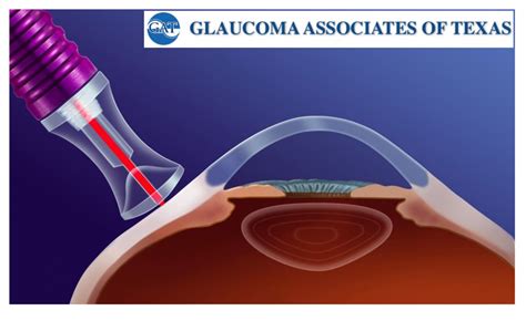 Micropulse Transscleral Cyclophotocoagulation Mp Tscpc Glaucoma