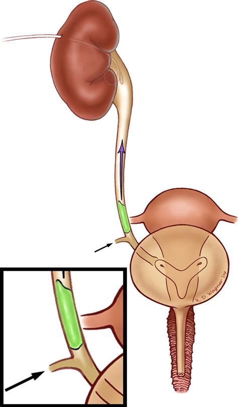 Fistulas Of The Lower Urinary Tract Percutaneous Approaches For The Management Of A Difficult