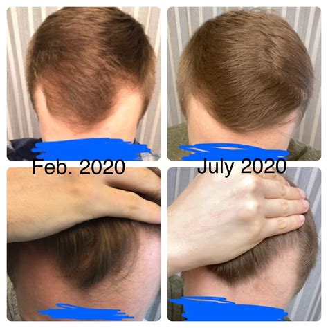 After Six Months Of Minoxidil Once Daily And Finasteride Im M26