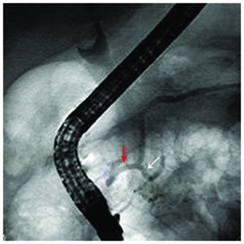Case 1 Endoscopic Image Reveals The Major Papilla White Arrow And