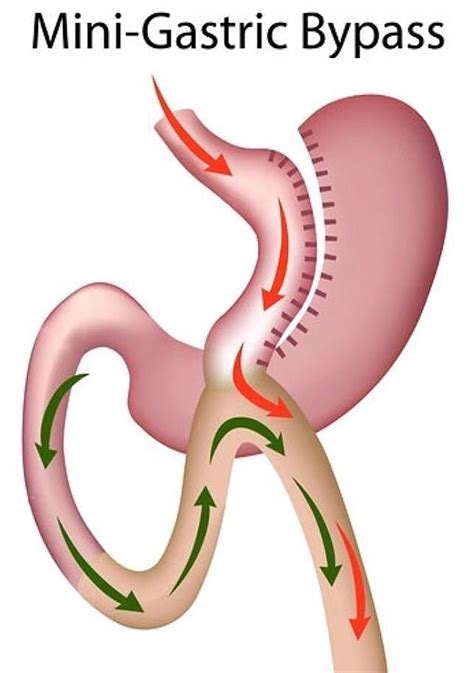 The Upper Is Bypassed Directly To The Small Intestine Gastric Bypass