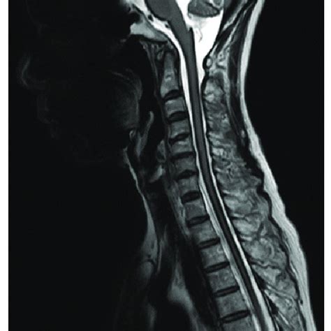 T Weighted MRI Of The Cervical To Upper Thoracic Spine Taken Three Download Scientific Diagram