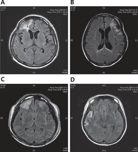 Factors Affecting Cognition And Emotion In Patients With Traumatic