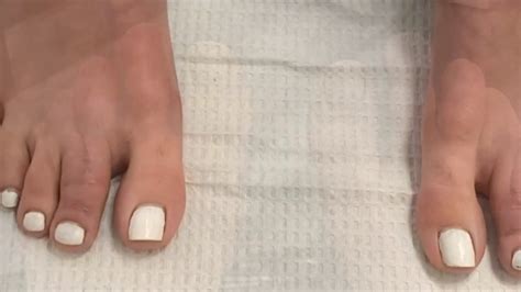 Before After Pictures Minimally Invasive Toe Shortening Surgery For