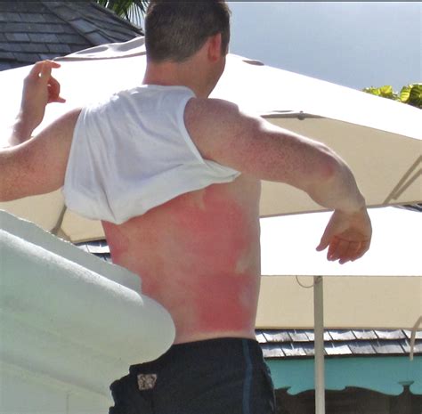 21 People Who Thought They Were Tougher Than The Sun Ouch Gallery