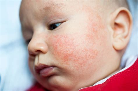 Eczema Ou Acne Infantil Como Dizer A Diferença Info Factory