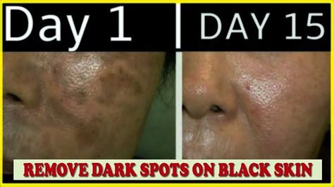 How To Get Rid Of Dark Spots On The Black Skin Removing Flickr