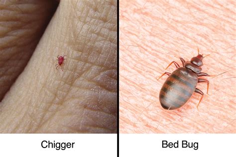 Chigger Bites Vs Bed Bug Bites How To Tell The Difference The Healthy