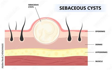 Anatomy Of Tumor And Cancer Bumps Under The Skin Of Sebaceous Cyst