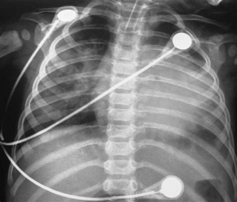 Chest X Ray Showing Cardiomegaly With Bilateral Pulmonary Congestion
