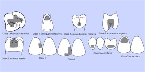 Clasificación De Las Cavidades Dentales Propuesta Por Gv Black