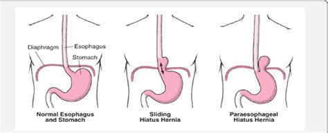 Figure 2 From Congenital Diaphragmatic Hernias A Review Article