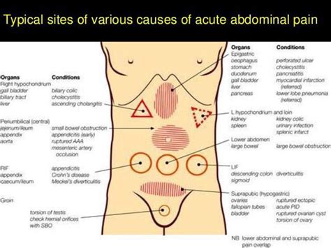 Regions Of Acute Abdominal Pain Very Important Clinically