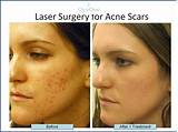 Pictures of What''s The Best Acne Treatment