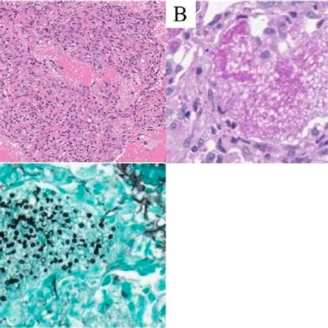 Pathological Images Of Transbronchial Lung Biopsy Tblb Specimens A