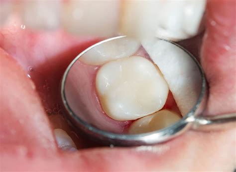 Natural White Composite Fillings Why They Are Better Vestal Dental
