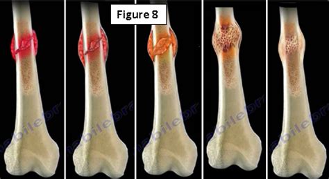 Bone Fracture Healing Process 17 Flow Chart Showing Phases Of