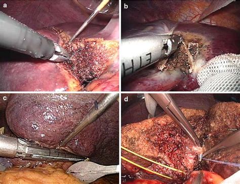 Liver Transplant Surgeon In Nagpur Liver Transplant Surgeon Liver