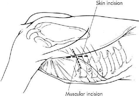 Figure 1 From Pain And Physical Function Are Similar Following Axillary