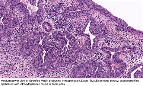 Pathology Outlines Adenocarcinoma In Situ