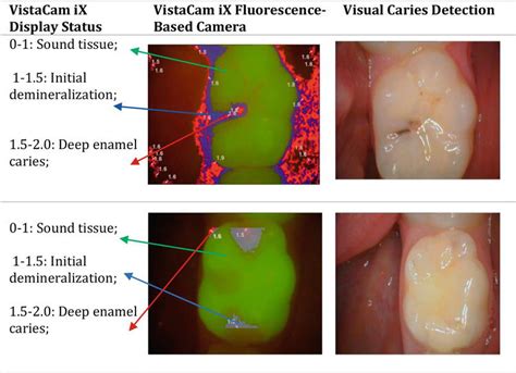 Caries Management Aided By Fluorescence Based Devices Intechopen