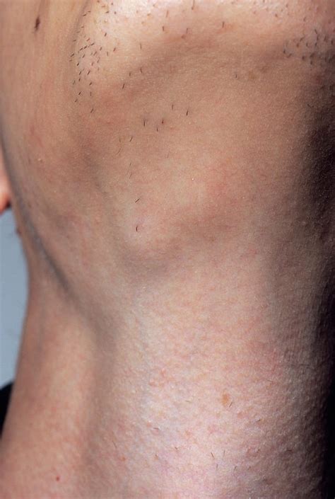 Swollen Lymph Nodes In Groin Chlamydia Actualpurpose