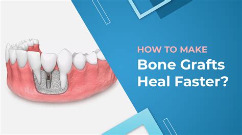 How To Make Bone Grafts Heal Faster Springvale Dental Blog