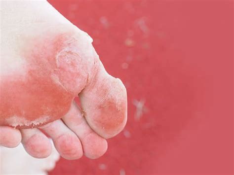 Athletes Foot Causes Symptoms Diagnosis Treatment And Prevention