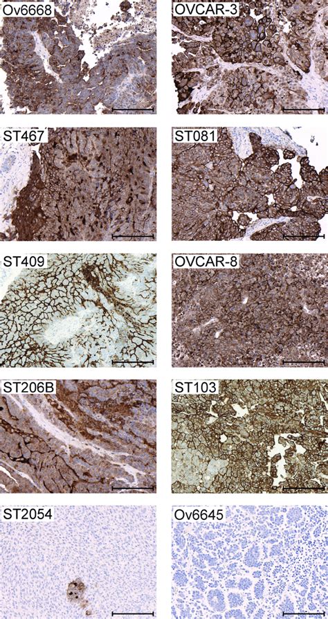 Mesothelin Expression In Ovarian Cancer Cell Line And Patient Derived