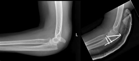 Olecranon Fracture Radiology At St Vincent S University Hospital My