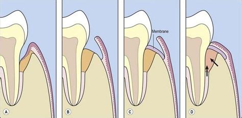 12 Periodontal Regeneration Pocket Dentistry