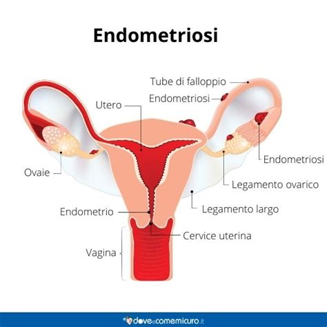 Endometriosi Sintomi Iniziali Sintomi E Conseguenze Dell Endometriosi